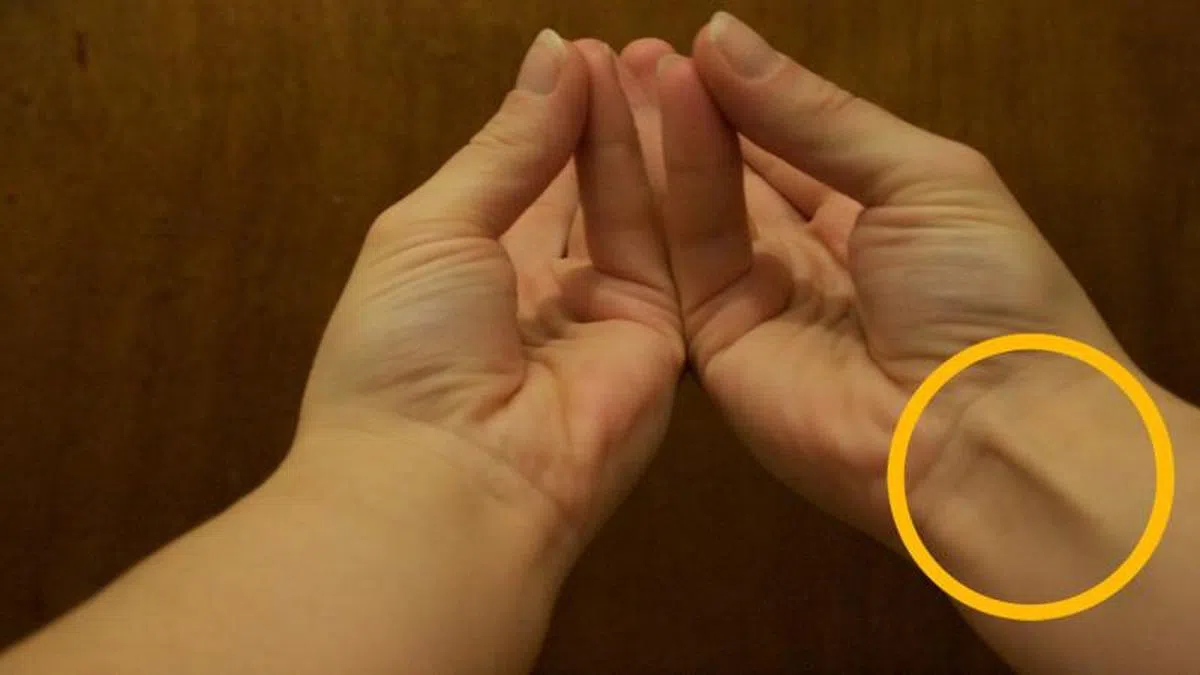 黄圈里的就是掌长肌。（互联网）