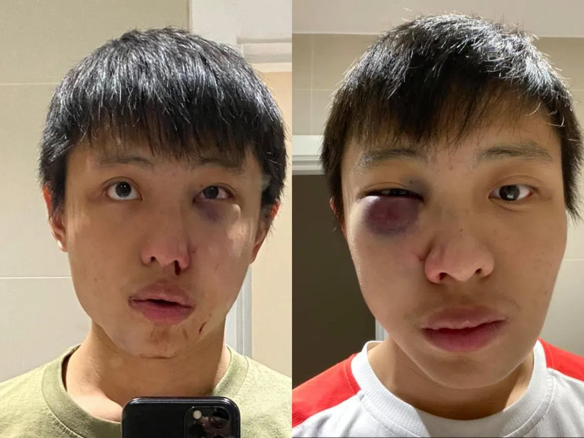 他右眼红肿，留下一大块淤青，鼻子也在流血。左图为遇袭当天所拍的，右图为隔天的自拍照（取自Jonathan Mok面簿）