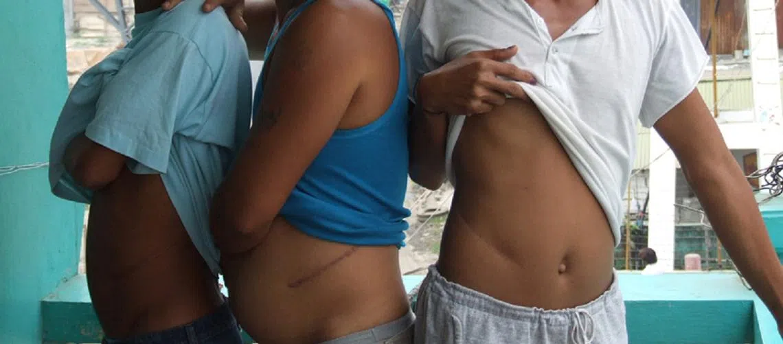 卖肾留下的手术疤痕。（ALISTAIR MCINDOE）