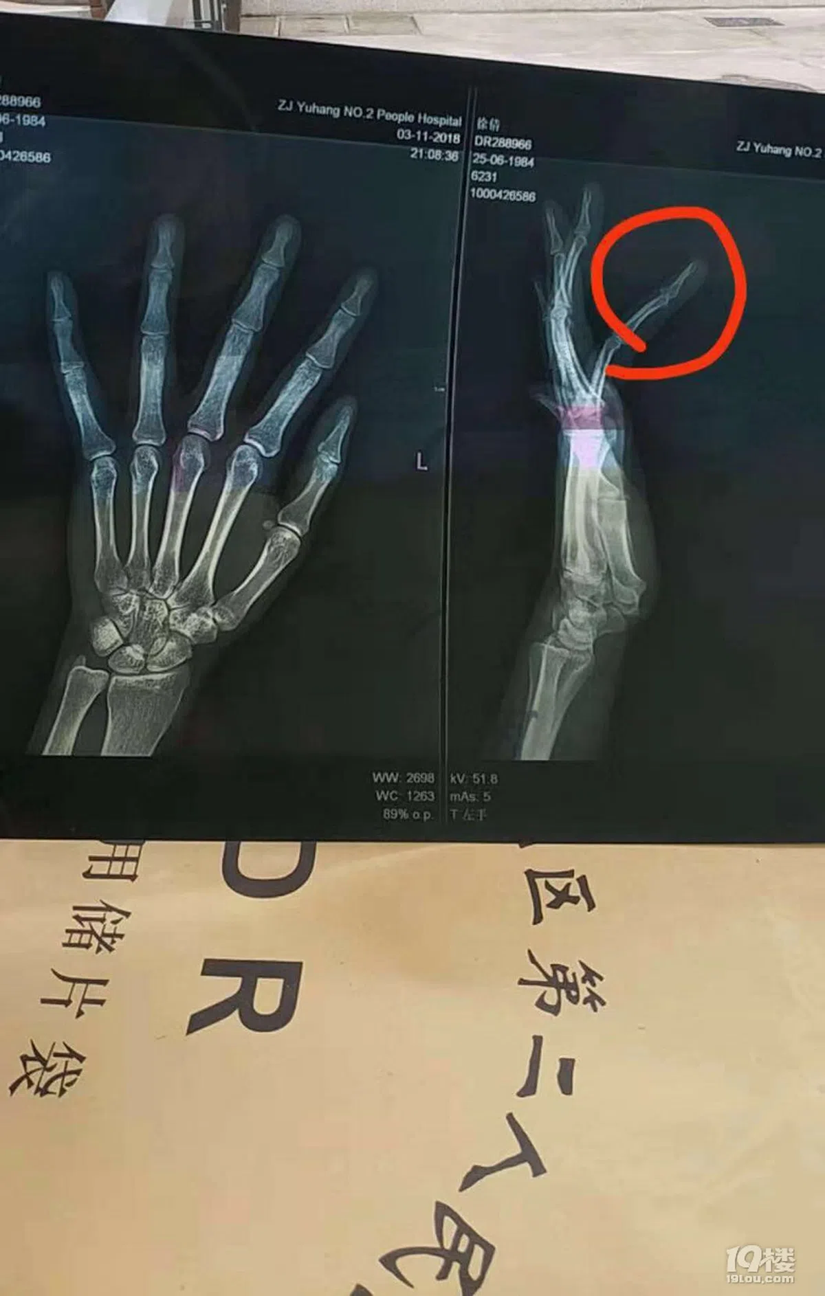  “19楼”中徐女士贴出自己左手的X光片 