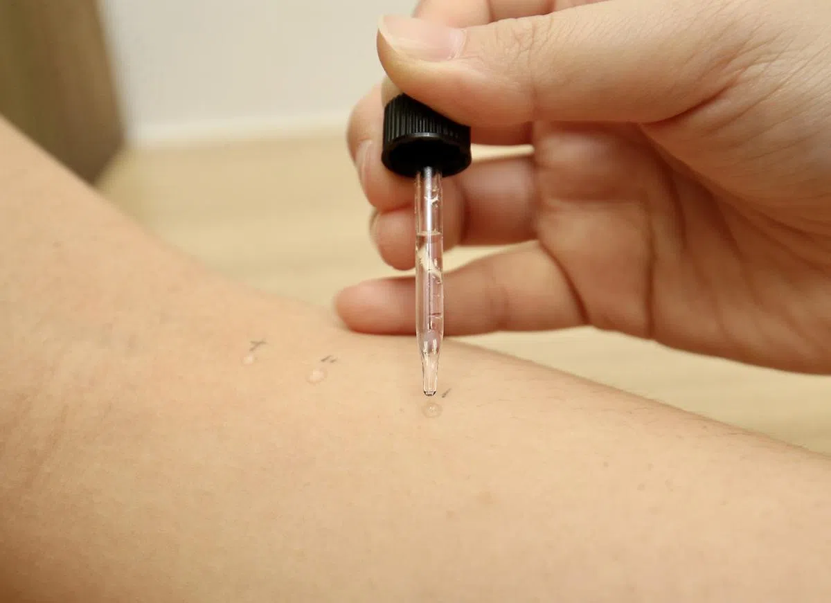 皮肤点刺测试可以快速测出孩子对哪些食物过敏。（联合早报）