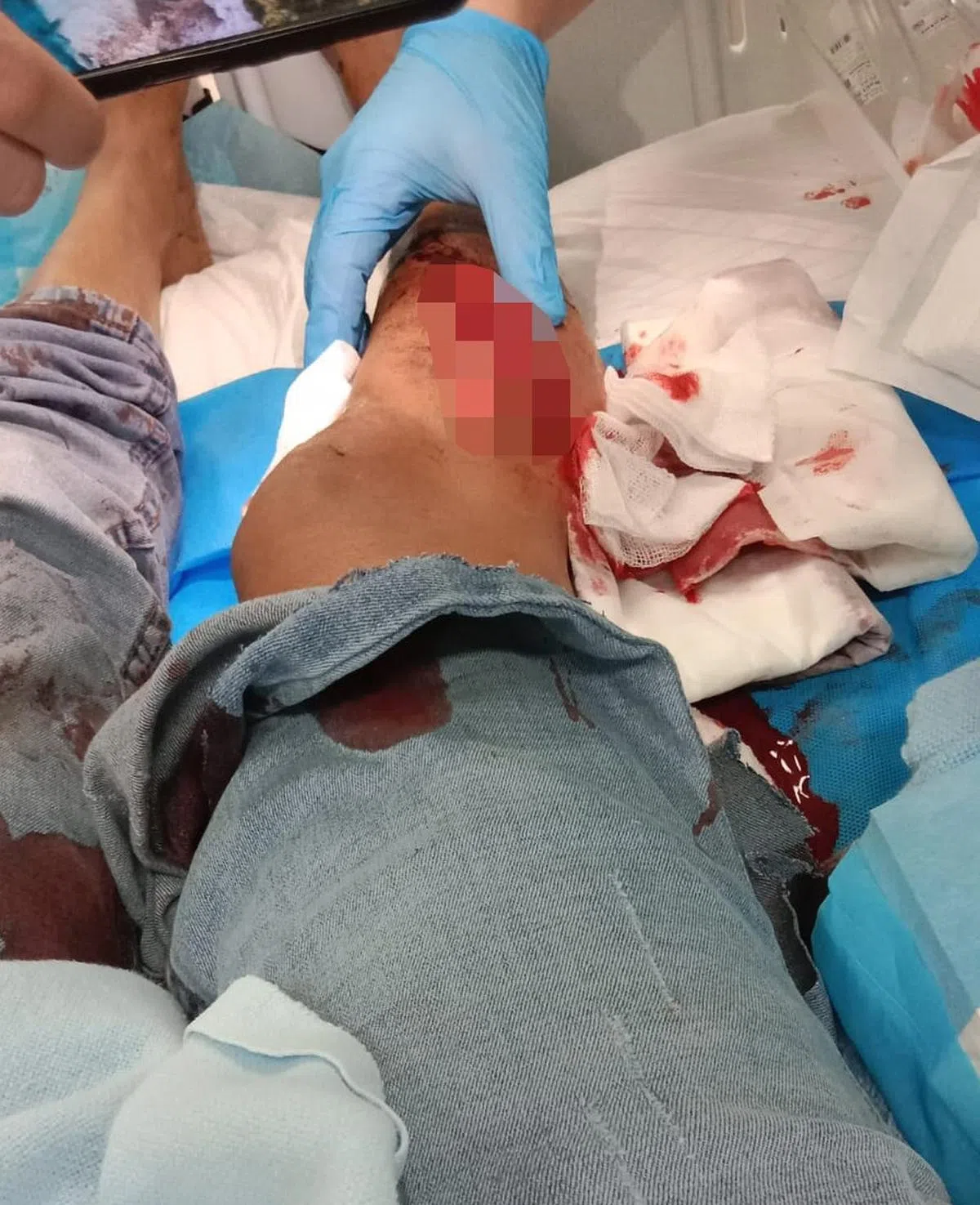 等巴士的女子右腿被野猪紧咬不放，把她甩到马路上后继续攻击，留下深可见骨的伤口。（Sri Devi脸书）