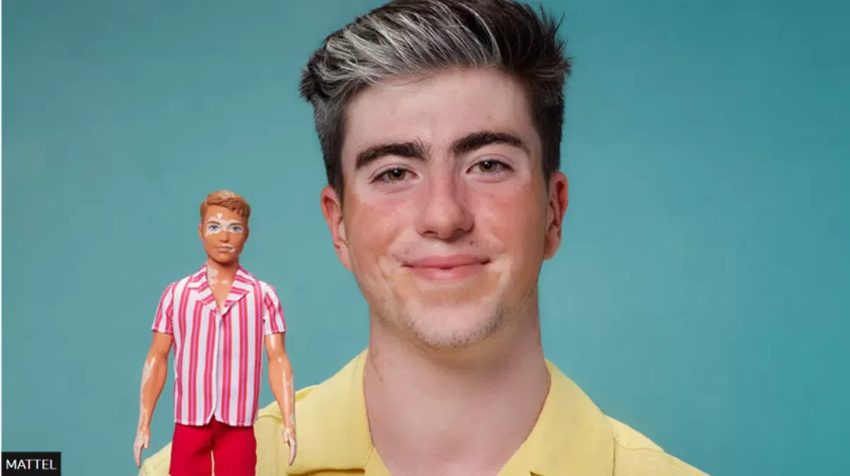 患有白癜风（Vitiligo）的男性娃娃。（美泰）