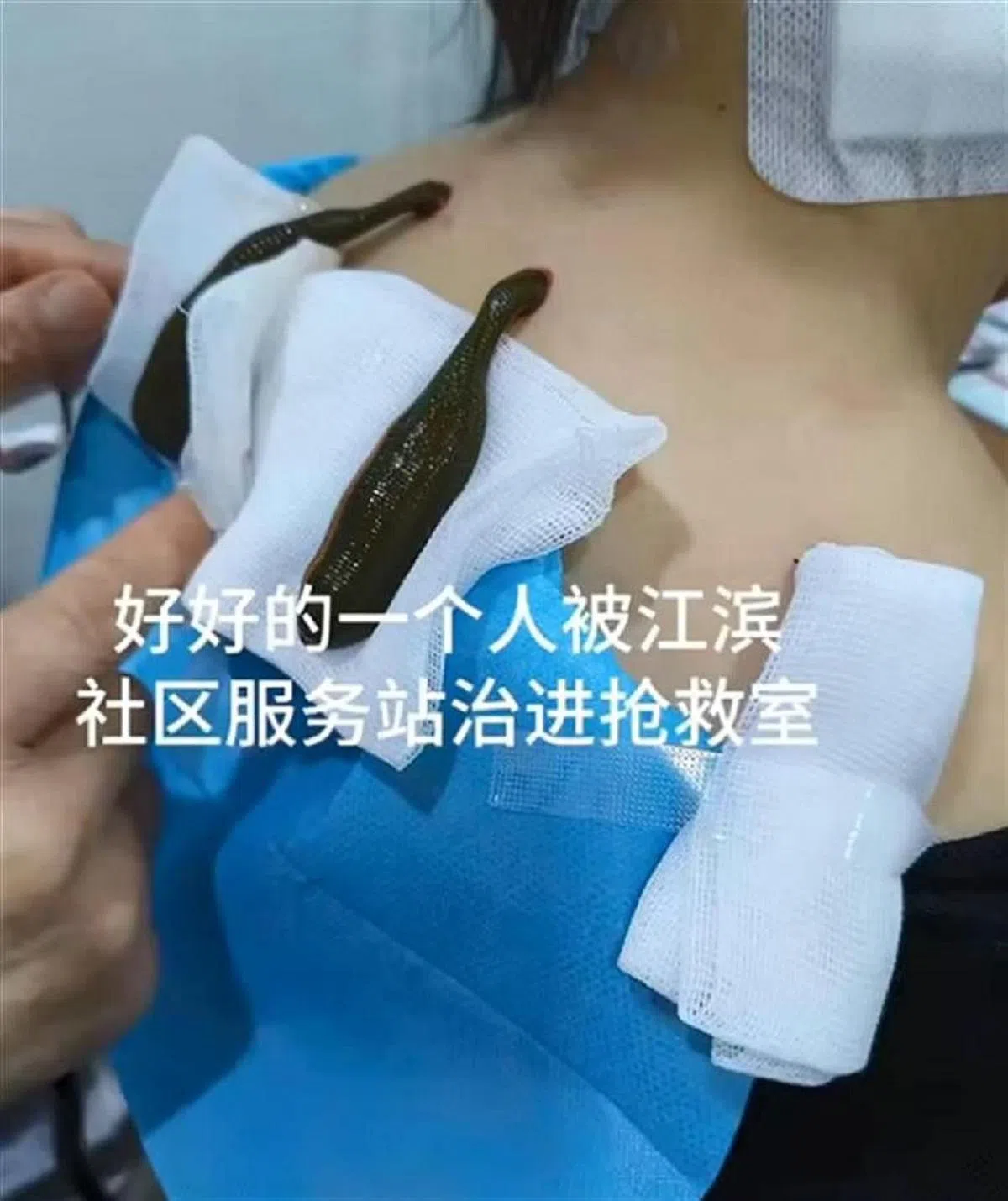 水蛭治疗。（视频截图）