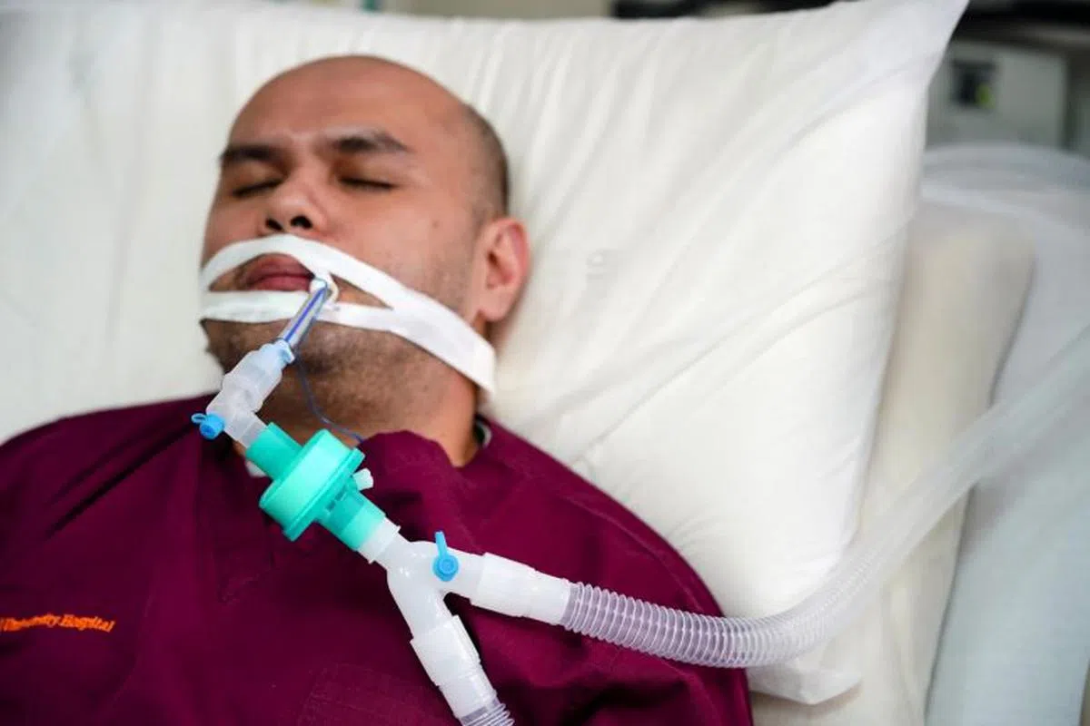  （示意图）患者从口腔插入一根呼吸管到气管内辅助呼吸。（新加坡国立大学医学组织提供） 