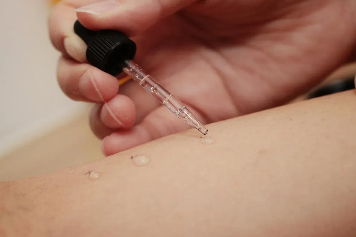 在本地常用的皮肤点刺试验中，只要将试液滴在皮肤上，然后用点刺针穿过液滴，轻轻刺入皮内，再观察皮肤的反应，就能知道病人的过敏情况。（海峡时报）