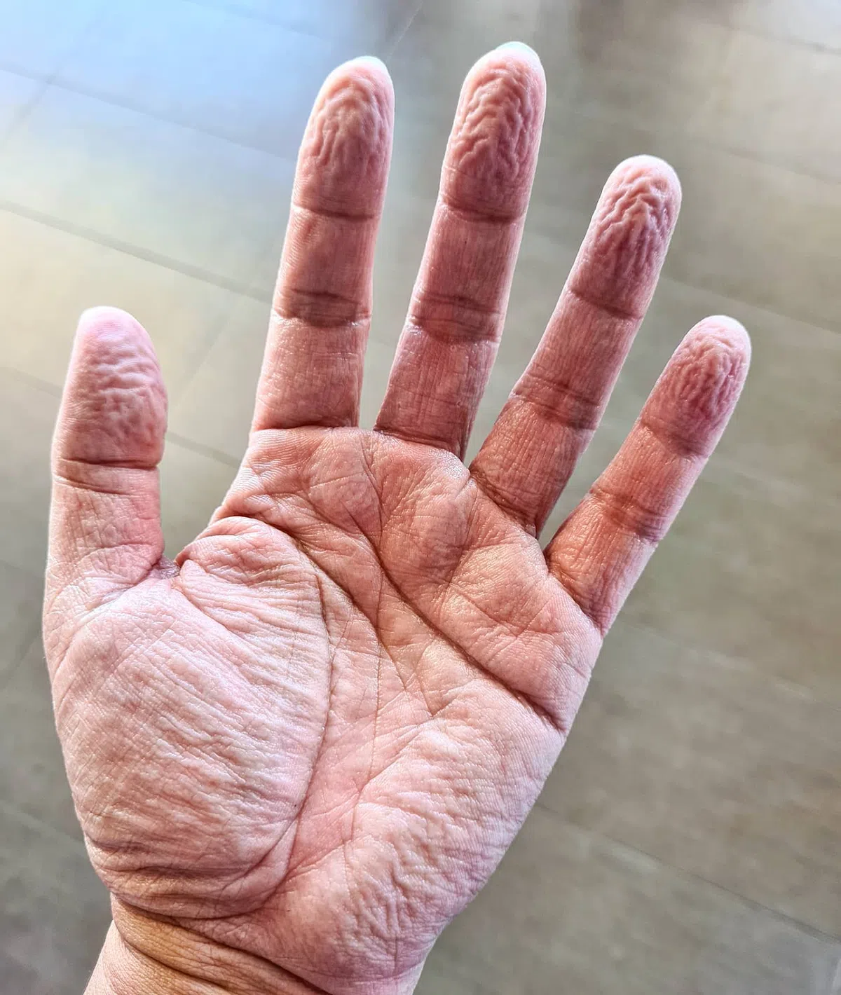  穿戴手套一个小时半后，Alex的手掌就出现皱褶。医护人员一般上都是穿戴至少四个小时。（Alex Chua面簿） 