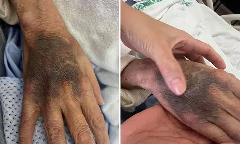 SGH apologises and explains bruising on elderly patient's hand