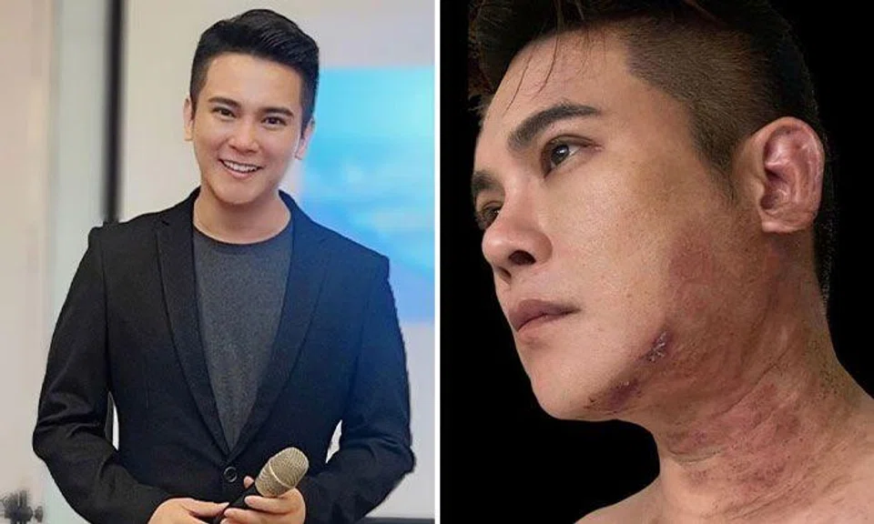 Nick Shen shares his painful battle against shingles to raise awareness