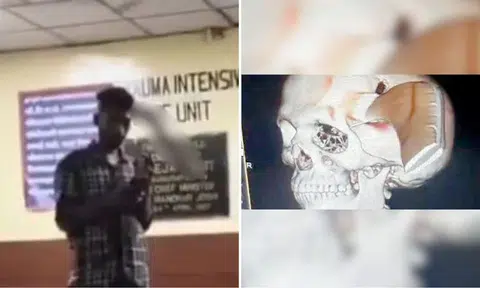 man in india walks into hospital with sickle stuck to his head 