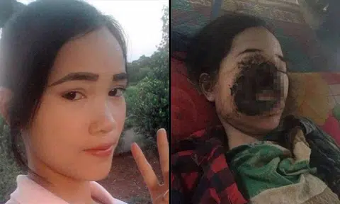 Cambodian girl's face destroyed by flesh-eating bacteria after visiting dentist