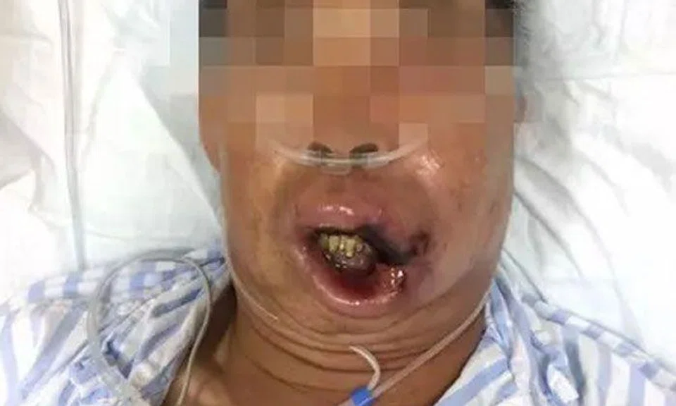 A doctor who treated the man said the area near the corner of his upper lip had turned black which signaled the tissue there had died. Photo: Weibo
