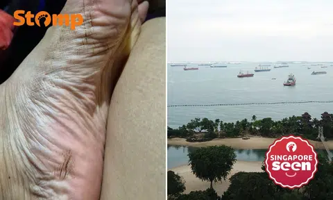 Beach fun cut short after woman allegedly steps on tar in Sentosa and develops dry, irritated skin