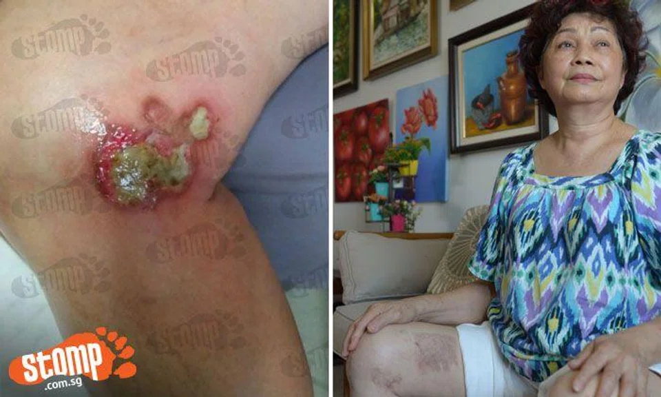 Botched TCM treatment leaves 70-year-old woman with nasty third-degree burns on both legs