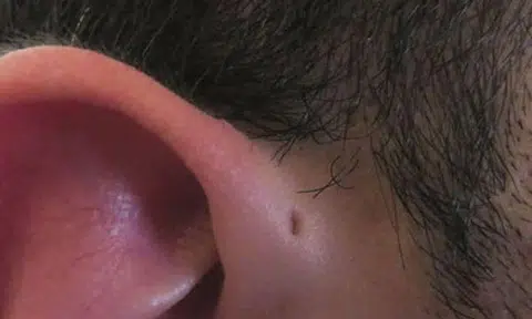 Ever wondered why some people have these little holes above their ears?