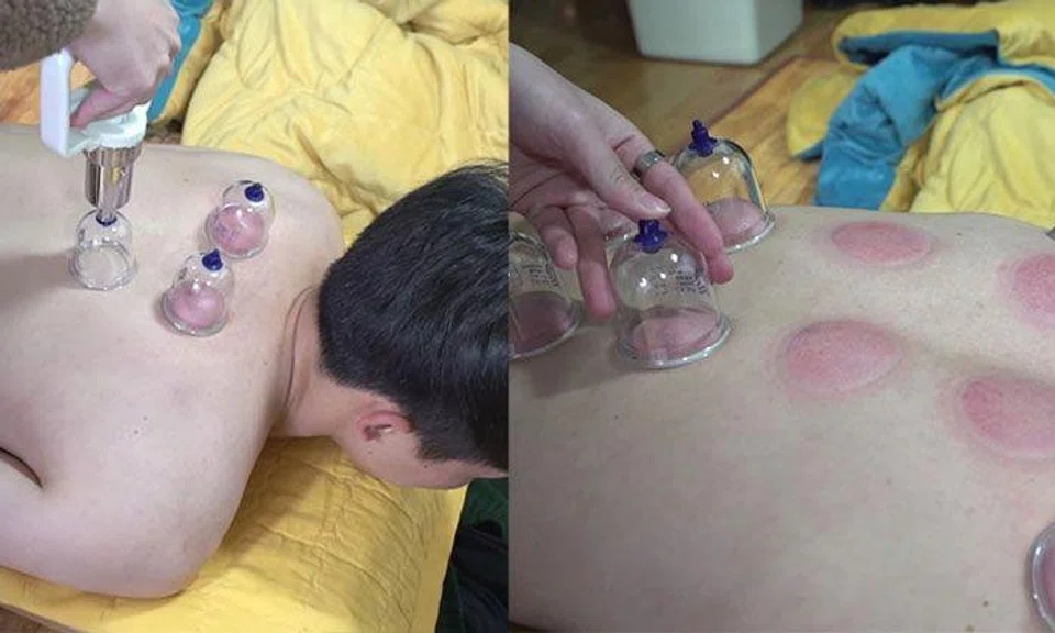 Is DIY cupping the same as getting it done by a doctor?