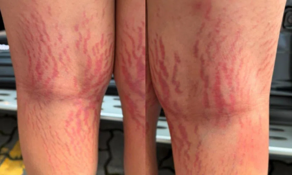 Boy, 12, gains 6kg, develops stretch marks after using ‘herbal’ eczema cream found on Facebook
