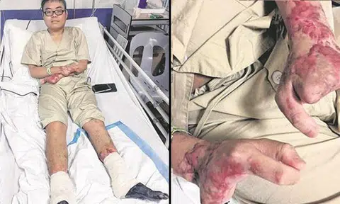 22-year-old youth contracts pneumonia, slips into coma and wakes up a month later -- only to require amputation