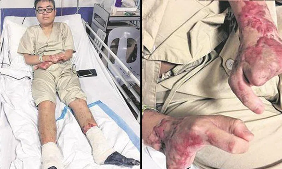 22-year-old youth contracts pneumonia, slips into coma and wakes up a month later -- only to require amputation