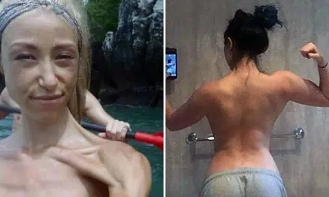 30kg anorexic woman turns her life around... and you'll marvel at how she looks like now