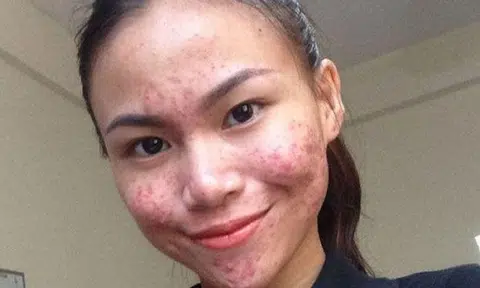 Pimply and pretty: 18-year-old Malaysian girl unafraid to flaunt her flawed skin