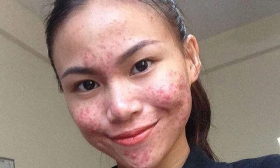 Pimply and pretty: 18-year-old Malaysian girl unafraid to flaunt her flawed skin