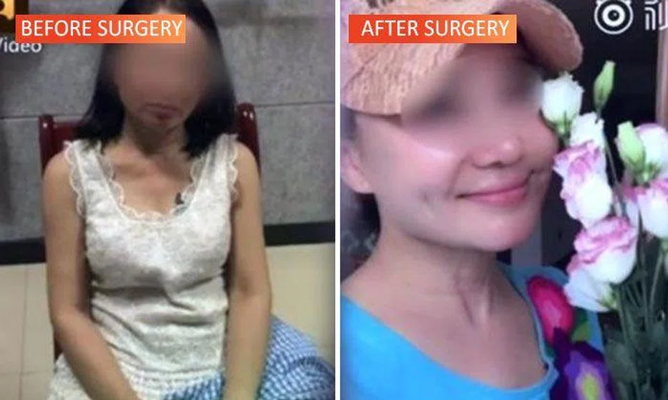 The 60-year-old woman underwent plastic surgery and "transformed" into a young lady in her 20s in order to evade her debtors. PHOTO: SHIN MIN DAILY NEWS