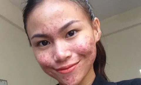 Pimply and pretty: 18-year-old Malaysian girl unafraid to flaunt her flawed skin