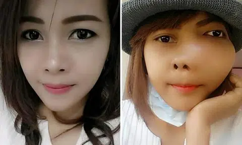 Thai woman with bone cancer disfigured by massive tumour on face