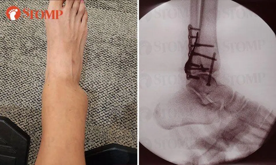 Woman suffers broken ankle after going down slide at indoor inflatable playground in Jurong East