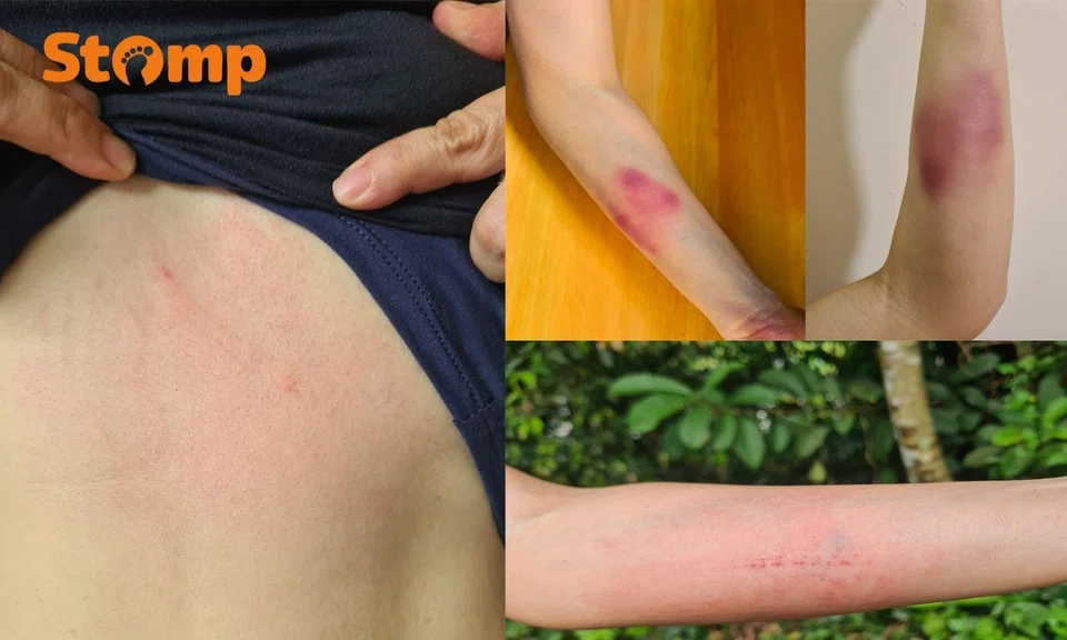Bruises on forearm