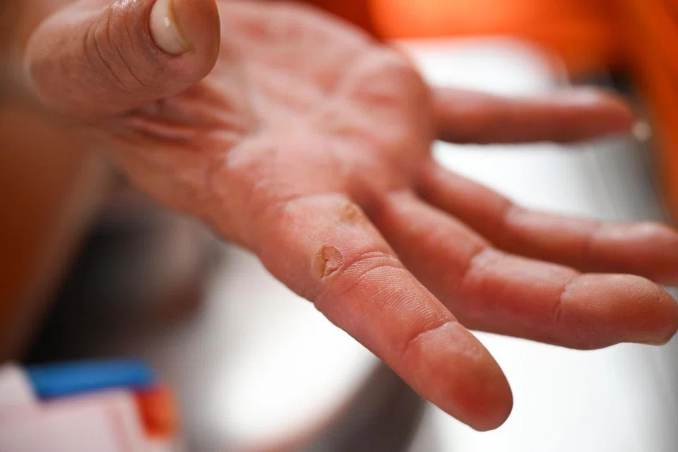 Blisters on Mr Cheong Peng Siong’s finger on Aug 10. ST PHOTO: SHINTARO TAY