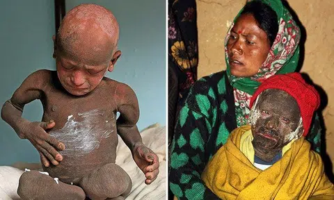 11-year-old Nepalese boy slowly turning into 'stone' due to incurable disorder