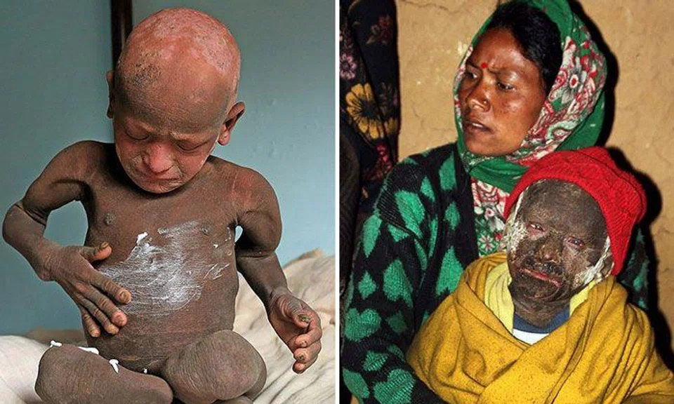 11-year-old Nepalese boy slowly turning into 'stone' due to incurable disorder