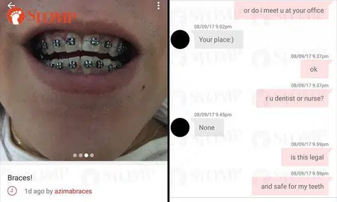Online seller advertises dental braces for just $300, says she is neither dentist nor nurse