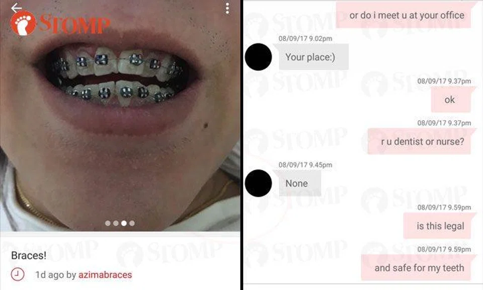 Online seller advertises dental braces for just $300, says she is neither dentist nor nurse
