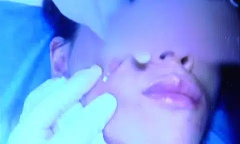 Malaysian woman regrets paying thousands to have gold threads sewn into her face to look 'hot and happening'