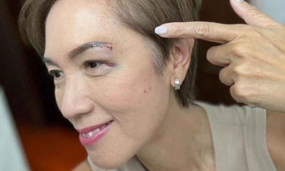 Minister for Digital Development and Information Josephine Teo suffered an inch-wide gash above her left eye after walking into glass door.