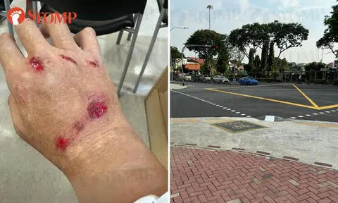 Cyclist's wrists broken and sprained after 'camouflaged' hump in Bishan causes accident