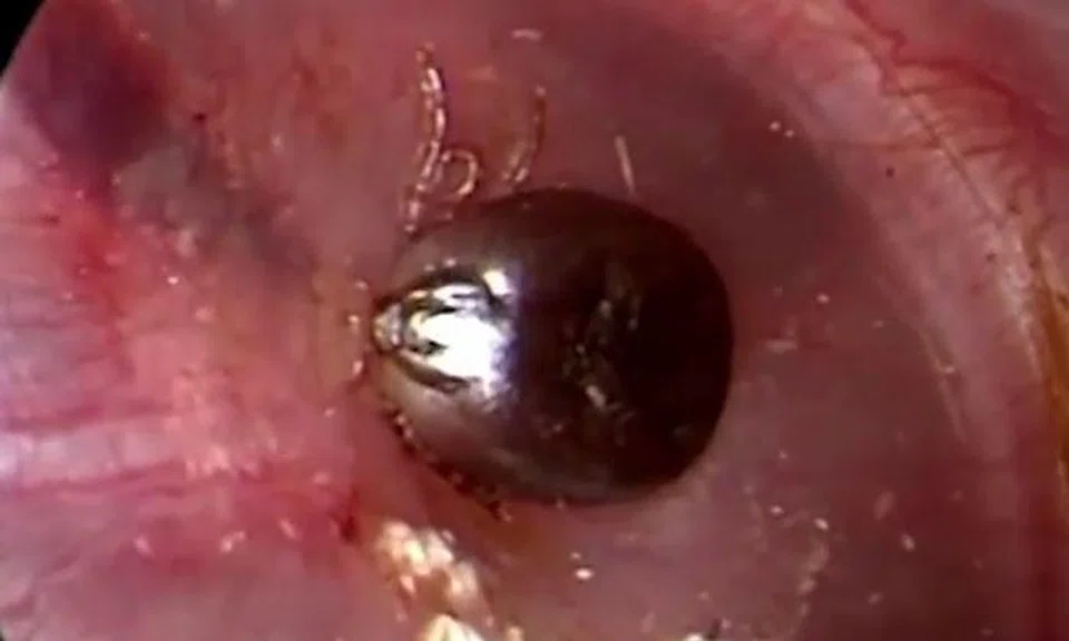 Flesh-eating parasite that has 8 legs removed from human ear -- along with some 'meat'