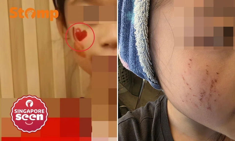 Child, 10, sustains scratches on face removing NDP tattoo, mother claims school did not call her