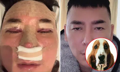 Addy Lee says botched plastic surgery in South Korea gave him 'suay' eyes like Hush Puppies dog