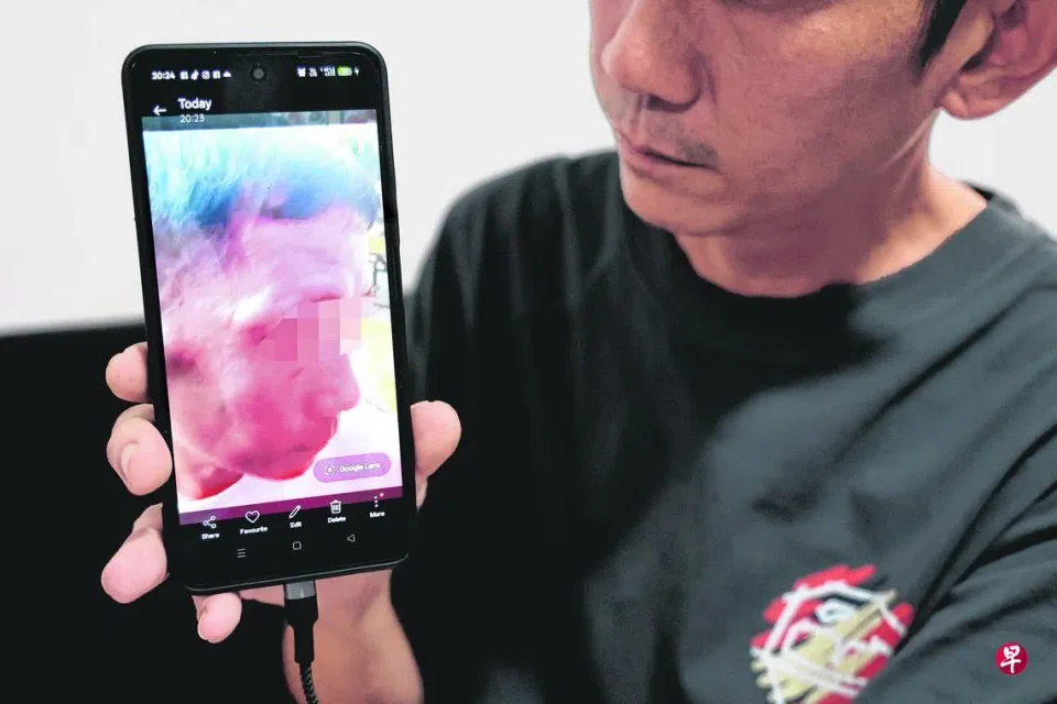 Mr Chen had bruises all over his face and body.