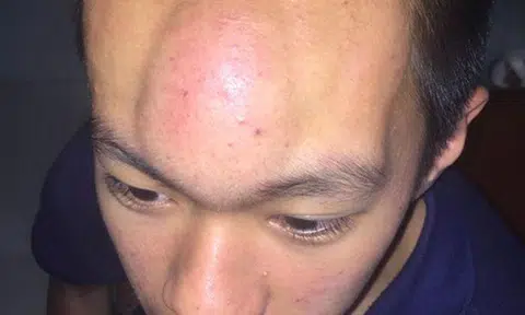 Man gets giant 'baluku' after getting flicked on forehead -- 200 times