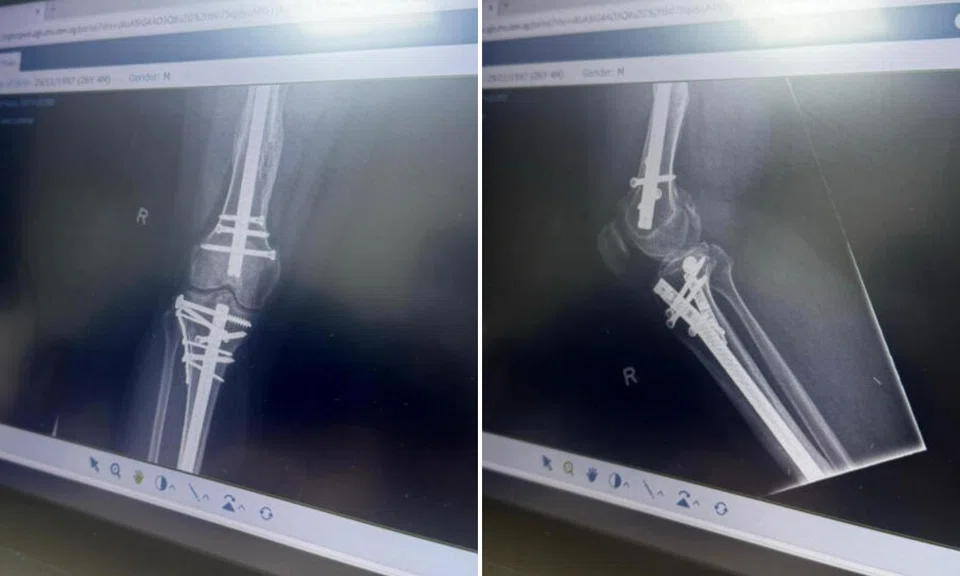 X-rays showing injuries and metal screws in Mr Mahmud’s right leg.