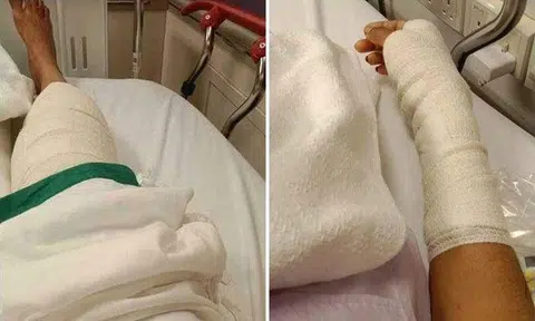 Animal lover suffers multiple wounds after wild boar attacks her 4 times along Bukit Panjang Road