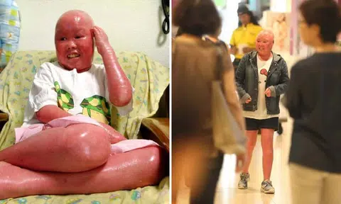 How S'pore woman with rare skin condition deals with unpleasant stares from passersby