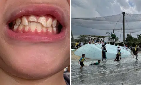 Boy breaks 2 front teeth playing at water slide, Bird Paradise closes playground until further notice