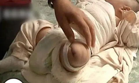 Baby undergoes amputation after nurse in China forgets to turn off hairdryer