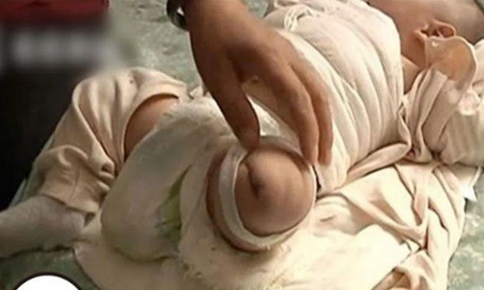 Baby undergoes amputation after nurse in China forgets to turn off hairdryer